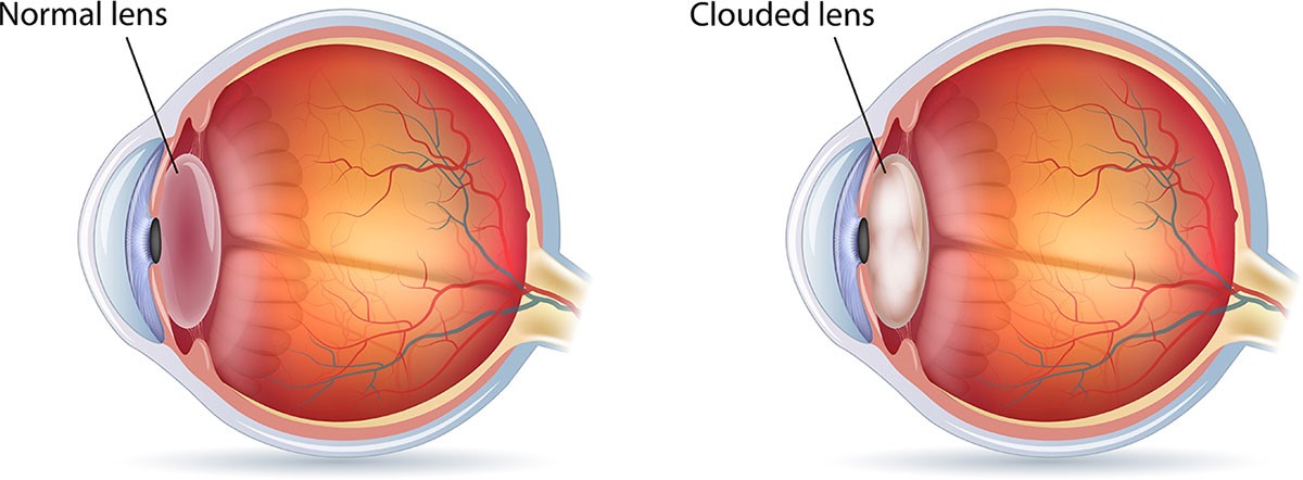 Cataract1