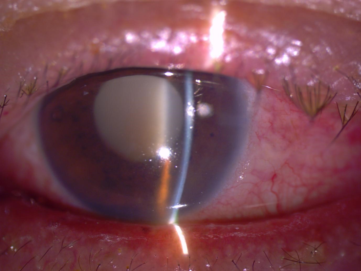 Cataract2