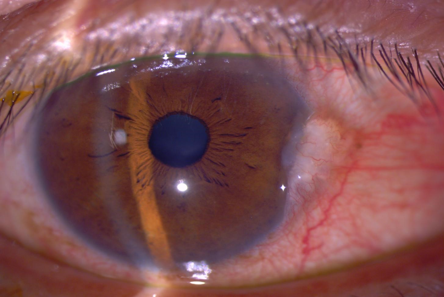 Pterygium